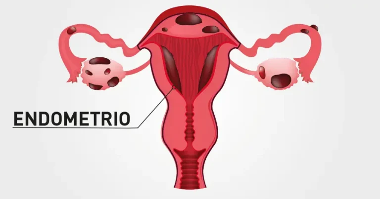 Scopri di più sull'articolo 28 marzo, giornata mondiale dell’endometriosi