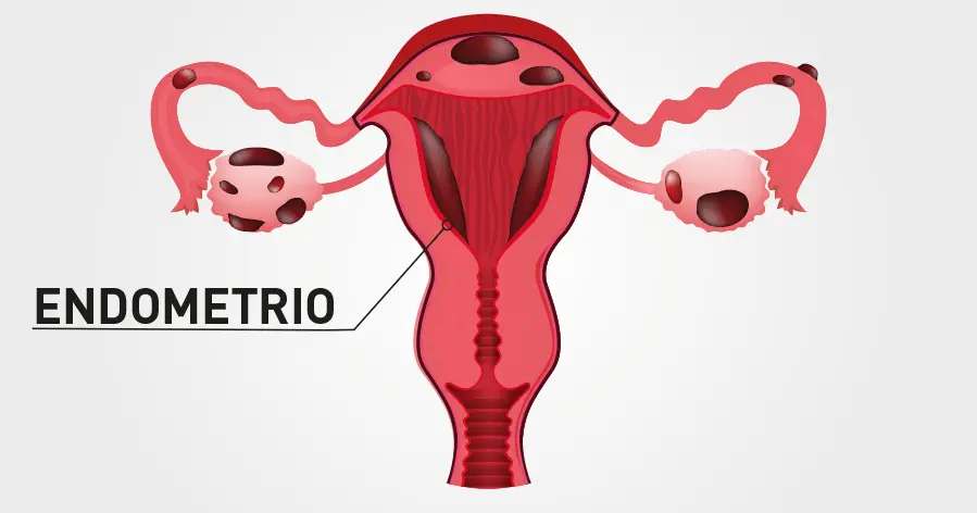 28 marzo, giornata mondiale dell’endometriosi